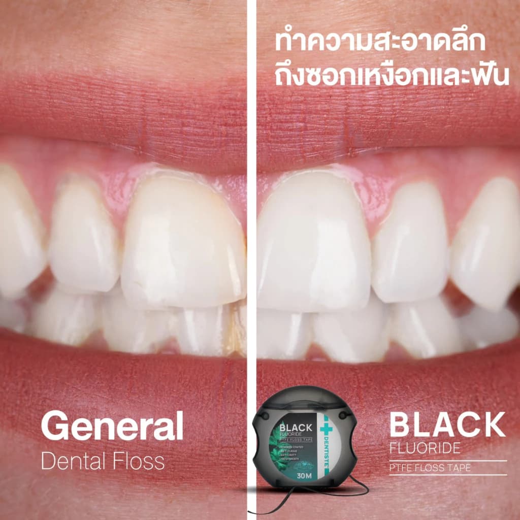 Dentiste' Dentiste Dental Black PTFE Floss Tape with Fluoride 30m ไหมขัดฟันเคลือบฟลูออไรด์ ขจัดคราบพลัค ป้องกันฟันผุ นุ่มพิเศษ ทำความสะอาดลึกถึงซอก https://lnwchill.com